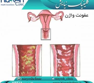 عفونت واژن کلینیک نیایش