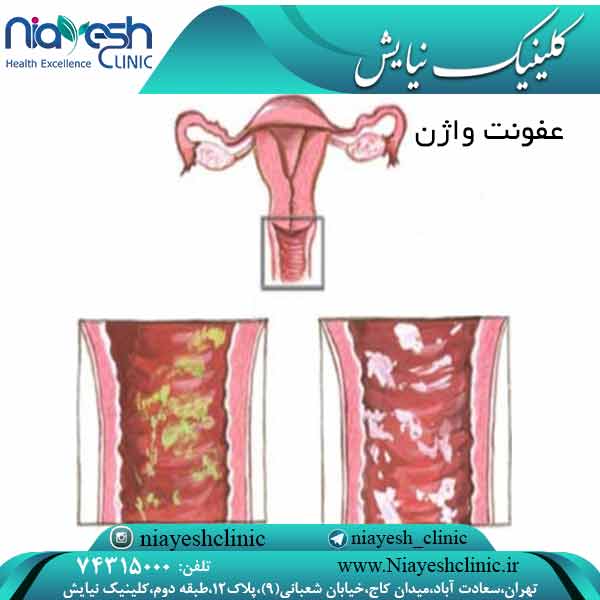 عفونت واژن کلینیک نیایش