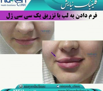 تزریق ژل لب کلینیک نیایش