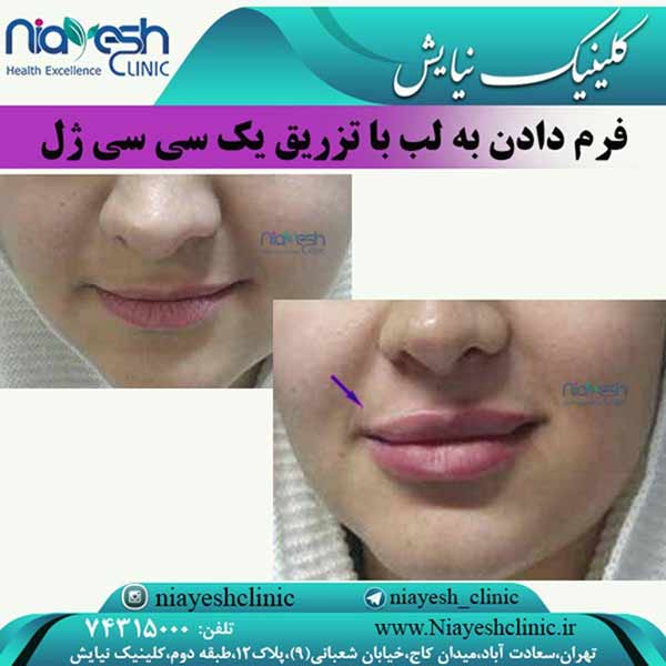 تزریق ژل لب کلینیک نیایش