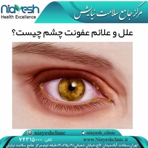 علل و علائم عفونت چشم چیست؟ کلینیک نیایش