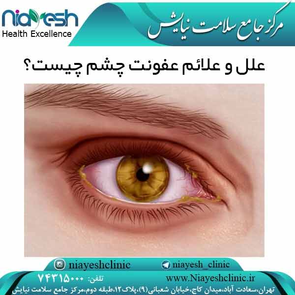 علل و علائم عفونت چشم چیست؟ کلینیک نیایش