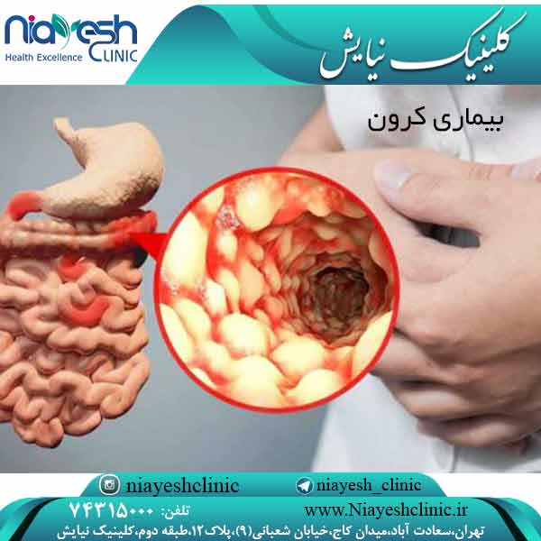 بیماری کرون کلینیک نیایش