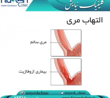 التهاب مری کلینیک نیایش