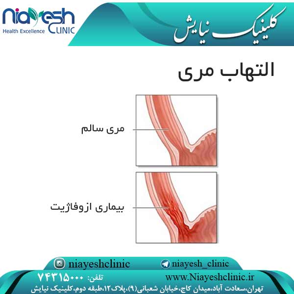التهاب مری کلینیک نیایش