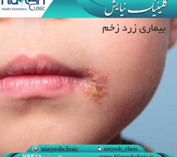 بیماری زرد زخم کلینیک نیایش