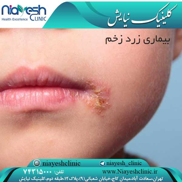 بیماری زرد زخم کلینیک نیایش