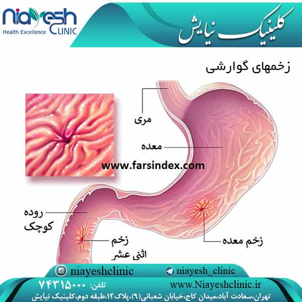زخمهای گوارشی کلینیک نیایش