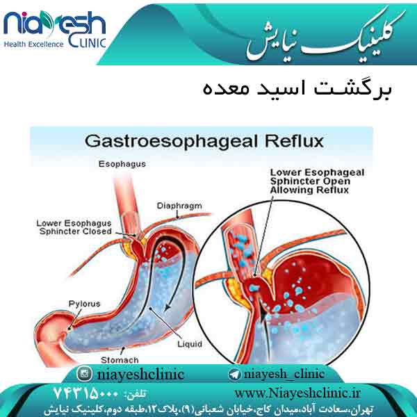برگشت اسید معده کلینیک نیایش