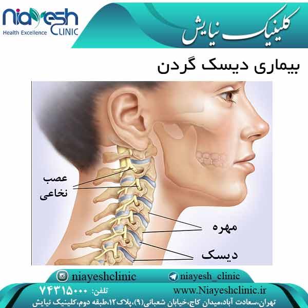 بیماری دیسک گردن کلینیک نیایش