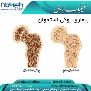 بیماری پوکی استخوان کلینیک نیایش
