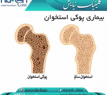 بیماری پوکی استخوان کلینیک نیایش
