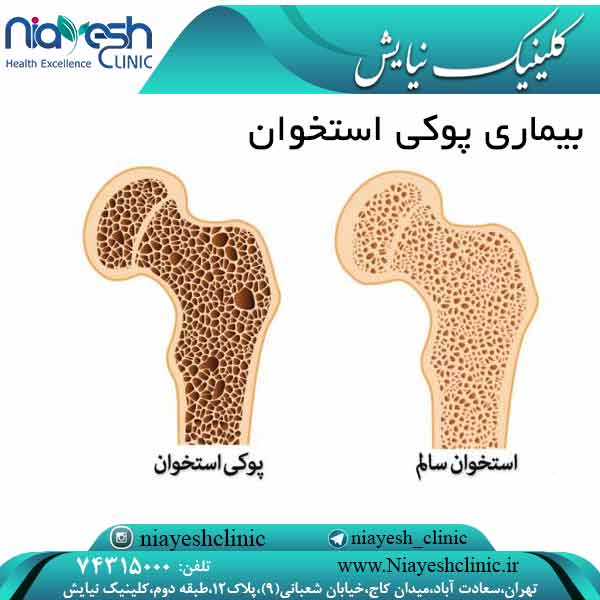 بیماری پوکی استخوان کلینیک نیایش