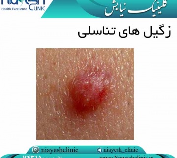 زگیل های تناسلی کلینیک نیایش