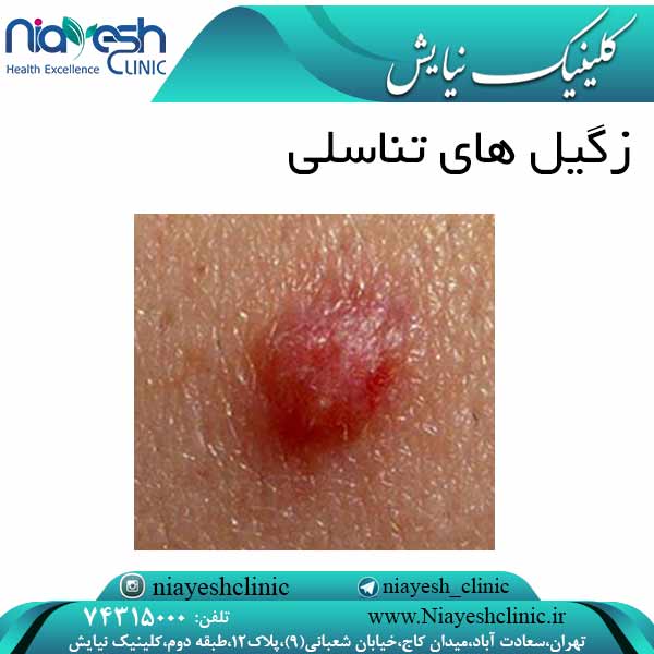 زگیل های تناسلی کلینیک نیایش