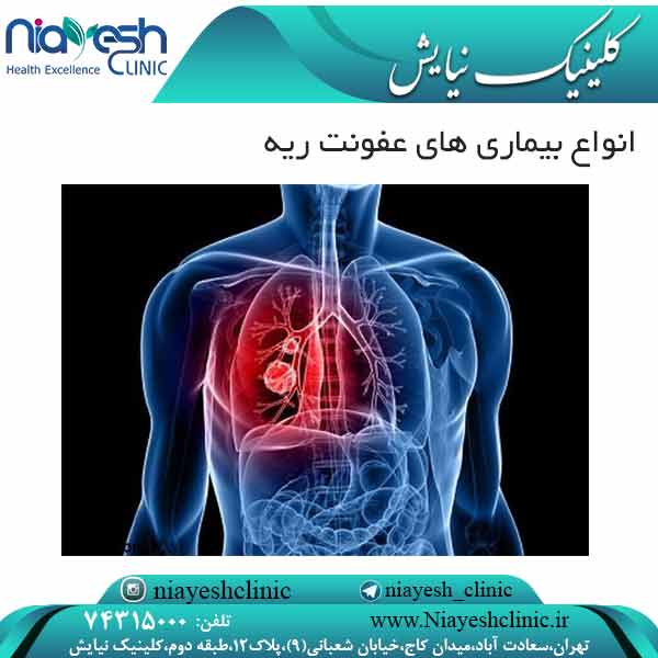 انواع بیماری های عفونت ریه کلینیک نیایش