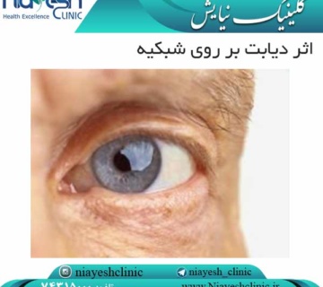 اثر دیابت بر روی شبکیه کلینیک نیایش