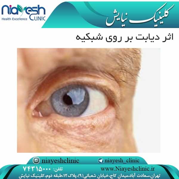 اثر دیابت بر روی شبکیه کلینیک نیایش