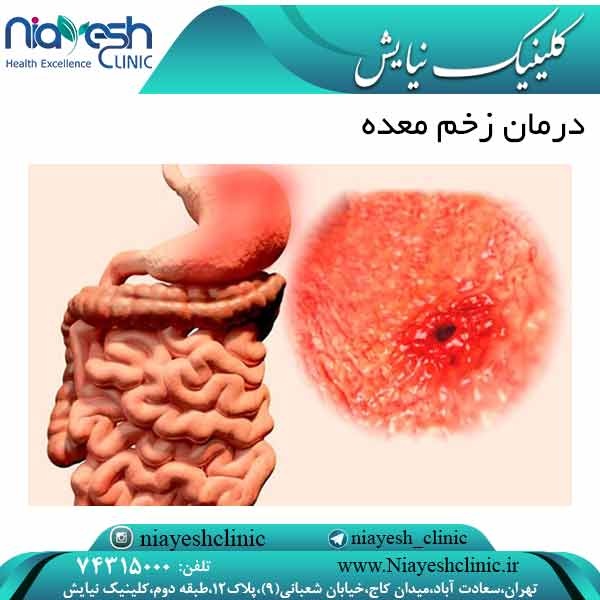 درمان زخم معده کلینیک نیایش