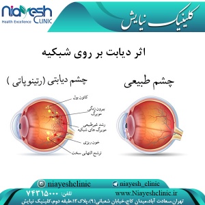اثر دیابت بر روی شبکیه