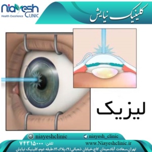 لیزیک