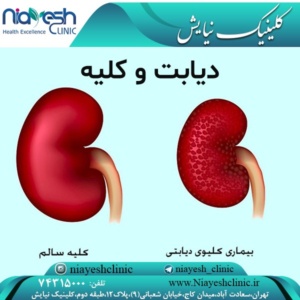 http://niayeshclinic.com/?p=3755&preview=true دیابت و کلیه