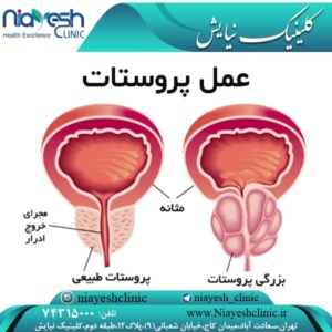 http://niayeshclinic.com/?p=3766&preview=true عمل پروستات
