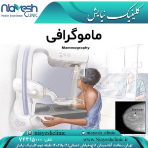 ماموگرافی