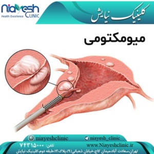 http://niayeshclinic.com/?p=3894&preview=true میومکتومی