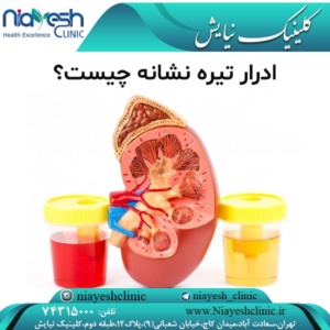 ادرار تیره نشانه چیست؟