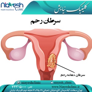 سرطان رحم