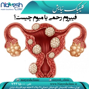 فیبروم رحمی یا میوم چیست؟