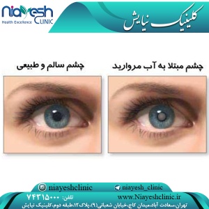 آب مروارید چیست و چگونه ایجاد میشود؟