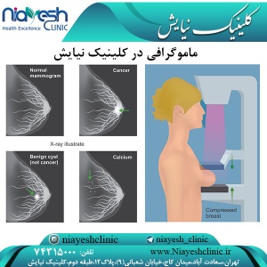 ماموگرافی در کلینیک نیایش