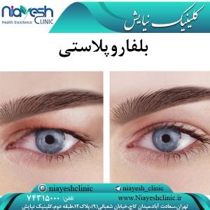بلفاروپلاستی