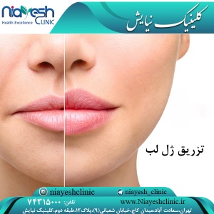 همه چیز در مورد تزریق ژل لب
