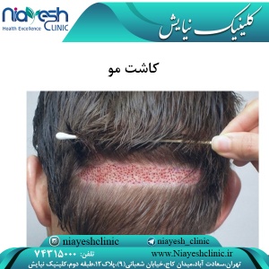 کاشت مو