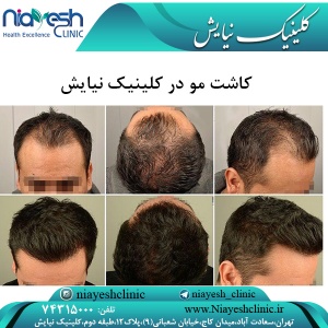 کاشت مو در کلینیک نیایش