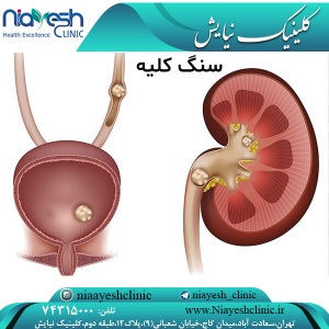 سنگ کلیه