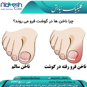 چرا ناخن ها در گوشت فرو می روند؟