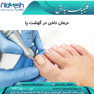 درمان ناخن در گوشت پا