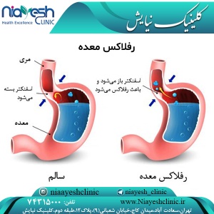 رفلاکس معده
