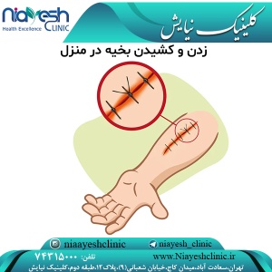 زدن و کشیدن بخیه در منزل