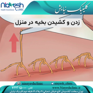 زدن و کشیدن بخیه در منزل