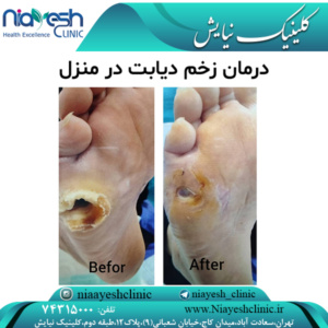 درمان زخم دیابت در منزل