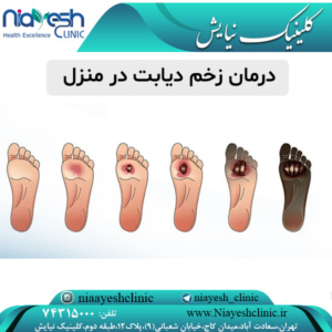درمان زخم دیابت در منزل