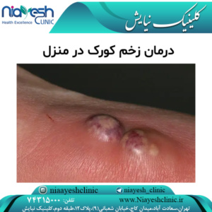 درمان زخم کورک در منزل